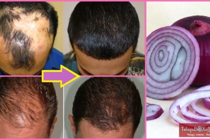 Hair Loss Treatment | Onion Juice for Hair Growth