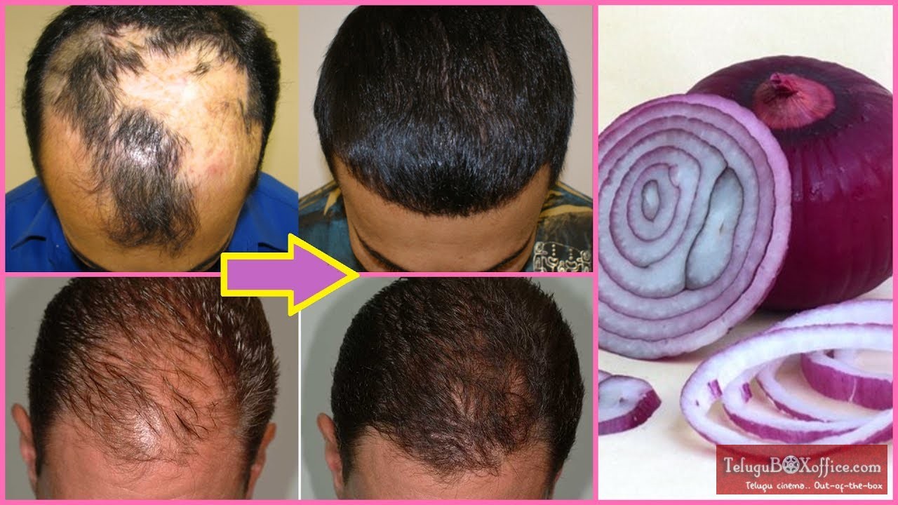 Hair Loss Treatment | Onion Juice for Hair Growth